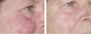 Facial Thread Veins Removal Glasgow
