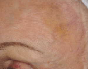 Facial Thread Vein Removal Aberdeen After