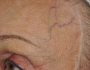 Facial Thread Vein Removal Aberdeen Before