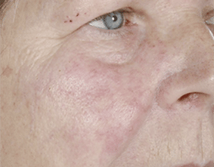 Facial Thread Veins Removal Glasgow After