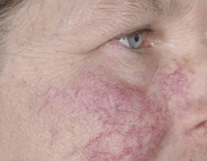 Facial Thread Veins Removal Glasgow Before