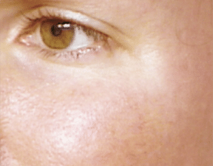 Facial Thread Veins Removal Scotland After