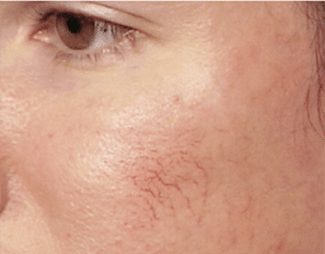 Facial Thread Veins Removal Scotland Before