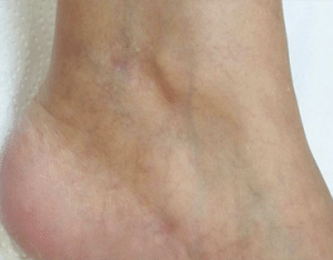 Leg Thread Veins Removal Glasgow After