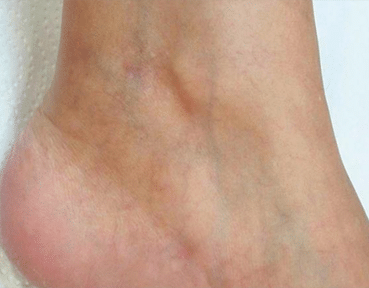 veins thread leg before surgery varicose vein