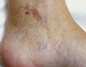 Leg Thread Veins Removal Glasgow Before