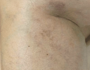 Leg Thread Veins Removal Scotland After