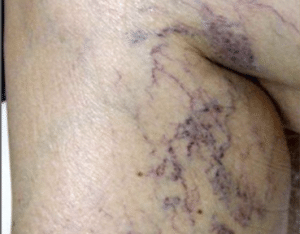 Leg Thread Veins Removal Scotland Before