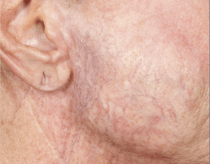 Thread Veins Removal Glasgow After