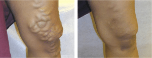Varicose Veins Treatment Glasgow
