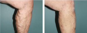 Varicose Veins Treatment Scotland